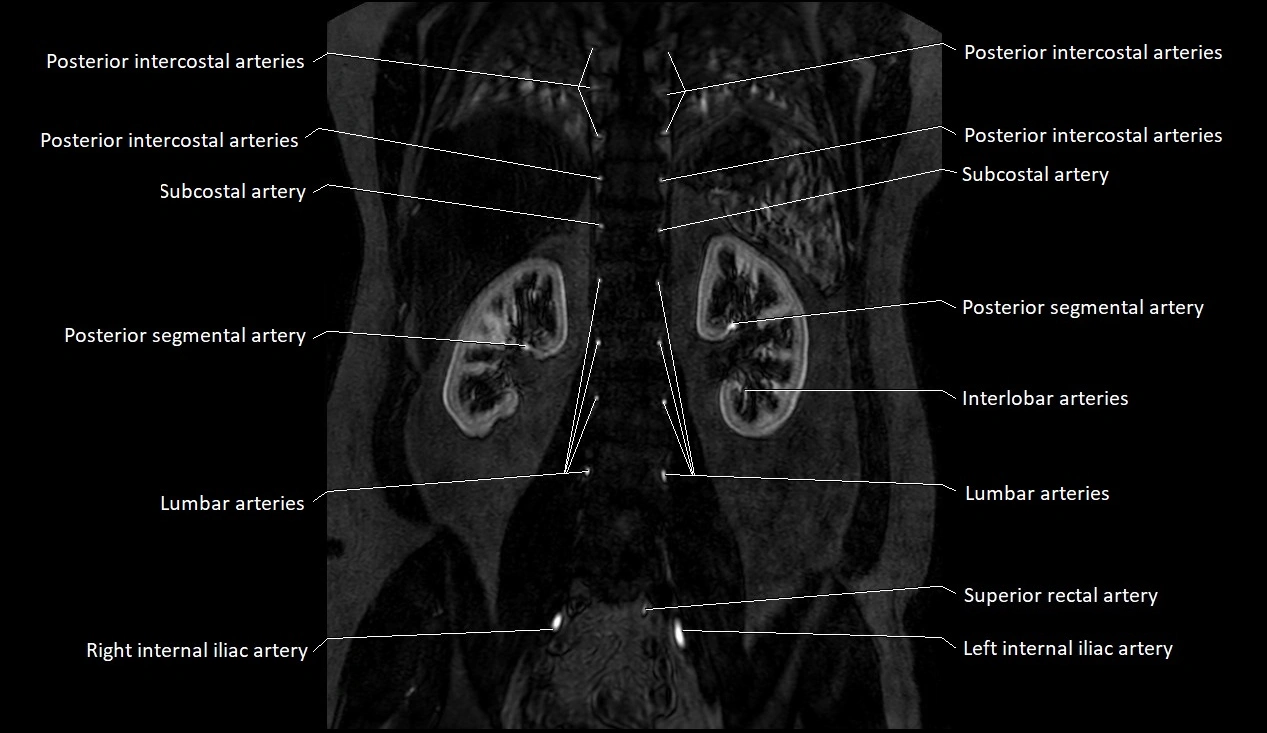 MRA Abdomen coronal anatomy image 38.webp